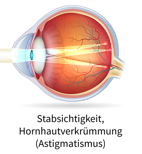 Astigmatismus Auge mit Stabsichtigkeit bzw. Hornhautverkrümmung (Astigmatismus)