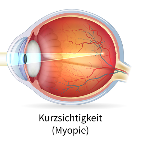 Myopie Auge mit Kurzsichtigkeit (Myopie)