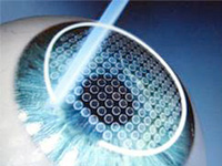 Femto Lasik Flap