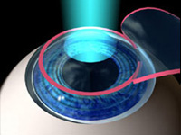 Lasik Laser